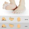 2 Toe Separators Straightener Toes Spacer Bunion Corrector Feet Foot Pain Relief